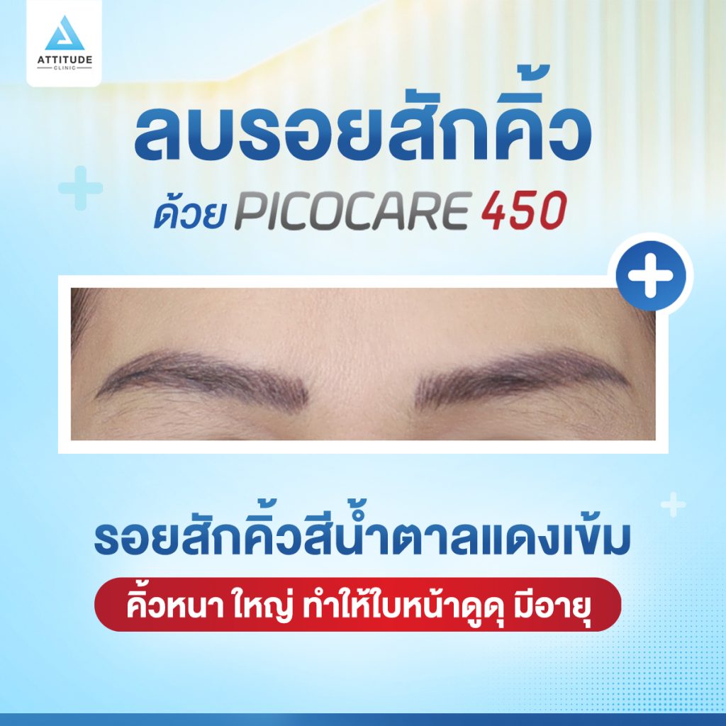 สักคิ้วพลาดมาก็ลบได้ ด้วย Picocare450 ที่แอททิจูด คลินิก