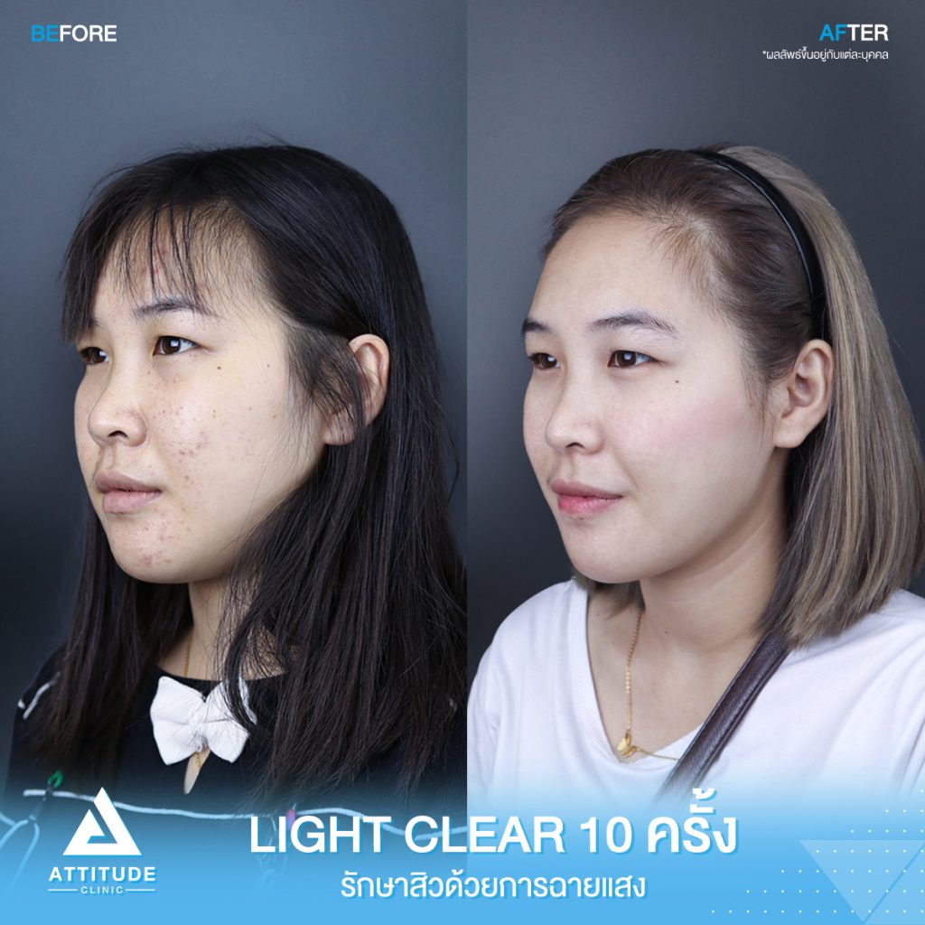 รีวิวรักษาสิวครบวงจร โปรแกรม Light Clear ด้วยการฉายแสง 7 ขั้นตอน จำนวน 10 ครั้ง ของน้องภานุกุล ที่มีปัญหาสิวอุดตัน สิวอักเสบสิว สิวฮอร์โมนและรอยแดงจากสิว