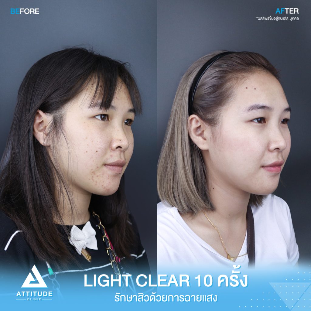 รีวิวรักษาสิวครบวงจร โปรแกรม Light Clear ด้วยการฉายแสง 7 ขั้นตอน จำนวน 10 ครั้ง ของน้องภานุกุล ที่มีปัญหาสิวอุดตัน สิวอักเสบสิว สิวฮอร์โมนและรอยแดงจากสิว