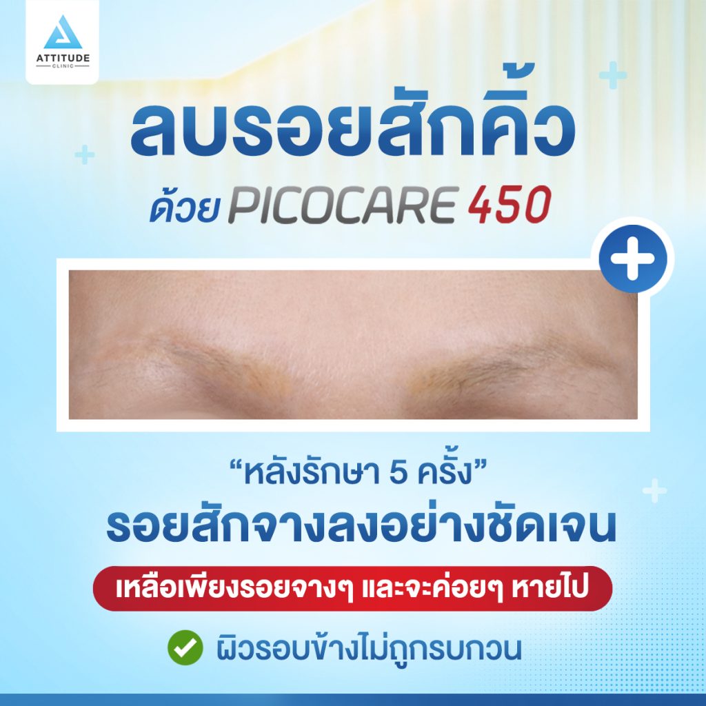 สักคิ้วพลาดมาก็ลบได้ ด้วย Picocare450 ที่แอททิจูด คลินิก