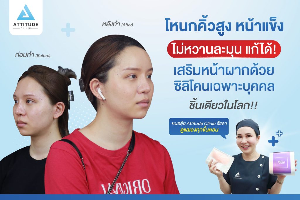 โหนกคิ้วสูง หน้าผากหน้าแข็งไม่หวานละมุน แก้ได้ด้วยการเสริมหน้าผากด้วยซิลิโคนเฉพาะบุคคล หมอยุ้ย Attitude Clinic รัชดา