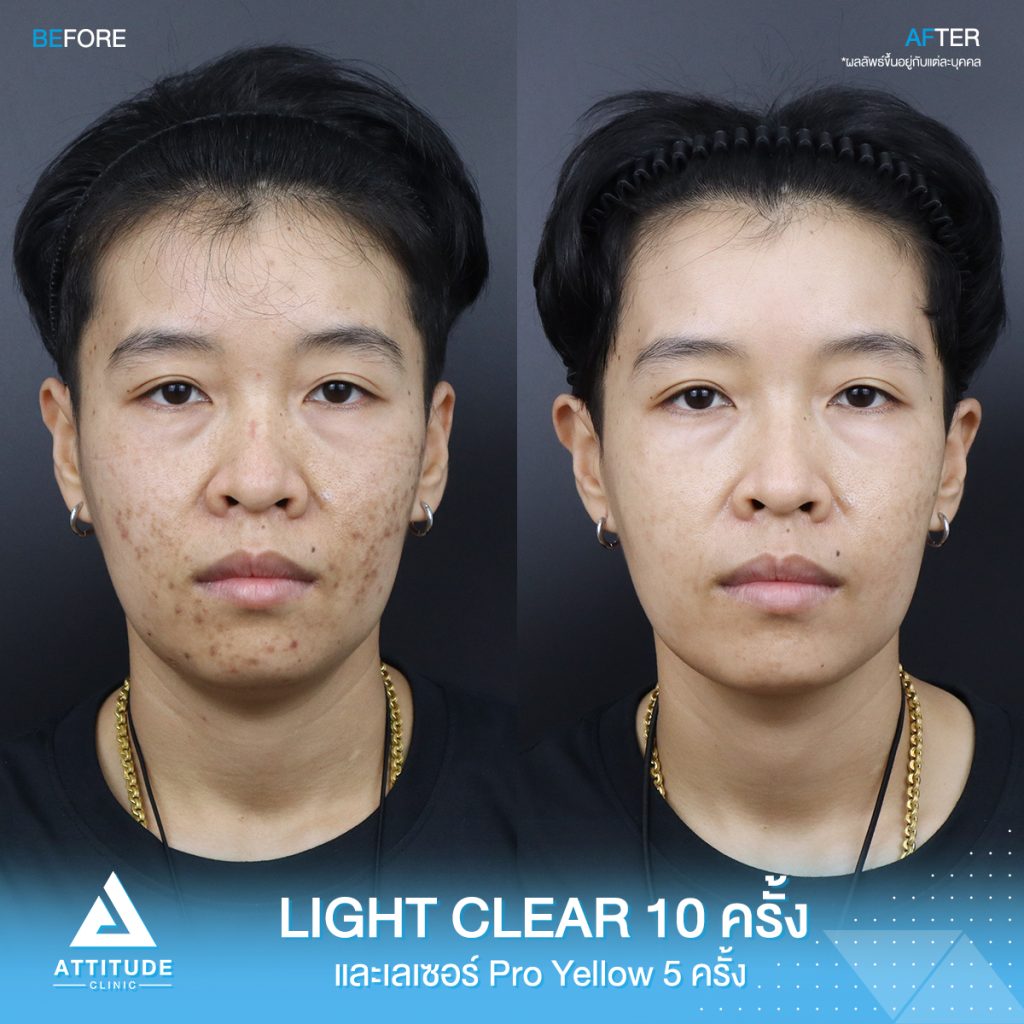 รีวิวรักษาสิวครบวงจร คุณเป้ โปรแกรม Light Clear รักษาสิวด้วยการฉายแสง 7 ขั้นตอน จำนวน 10 ครั้ง และเลเซอร์ Pro Yellow ลดรอยแดงโดยเฉพาะ จำนวน 5 ครั้ง