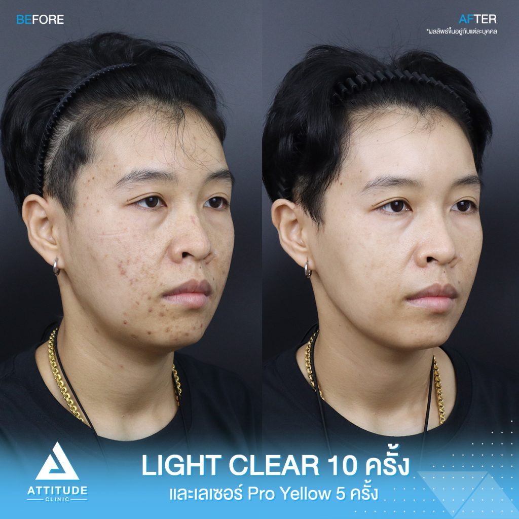 รีวิวรักษาสิวครบวงจร คุณเป้ โปรแกรม Light Clear รักษาสิวด้วยการฉายแสง 7 ขั้นตอน จำนวน 10 ครั้ง และเลเซอร์ Pro Yellow ลดรอยแดงโดยเฉพาะ จำนวน 5 ครั้ง