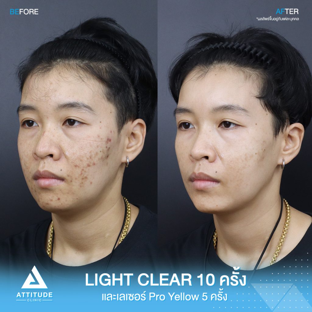 รีวิวรักษาสิวครบวงจร คุณเป้ โปรแกรม Light Clear รักษาสิวด้วยการฉายแสง 7 ขั้นตอน จำนวน 10 ครั้ง และเลเซอร์ Pro Yellow ลดรอยแดงโดยเฉพาะ จำนวน 5 ครั้ง