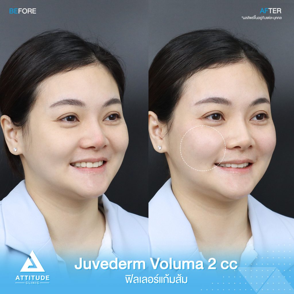 รีวิวฉีดฟิลเลอร์แก้มส้ม Juvederm Voluma จำนวน 2 cc เติมเต็มช่วงหน้าแก้ม เพิ่มมิติให้ใบหน้า เต็มอิ่มสวย หน้าดูเด็กลง เป็นธรรมชาติ โดยแพทย์ผู้เชี่ยวชาญ