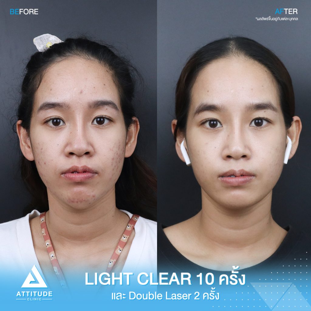 รีวิวรักษาสิวครบวงจร คุณใหม่ โปรแกรม Light Clear รักษาสิวด้วยการฉายแสง 7 ขั้นตอน จำนวน 10 ครั้ง เลเซอร์หน้าใส Cellec V IPL จำนวน 2 ครั้ง เลเซอร์ลดเม็ดสี Q-Switched จำนวน 2 ครั้ง