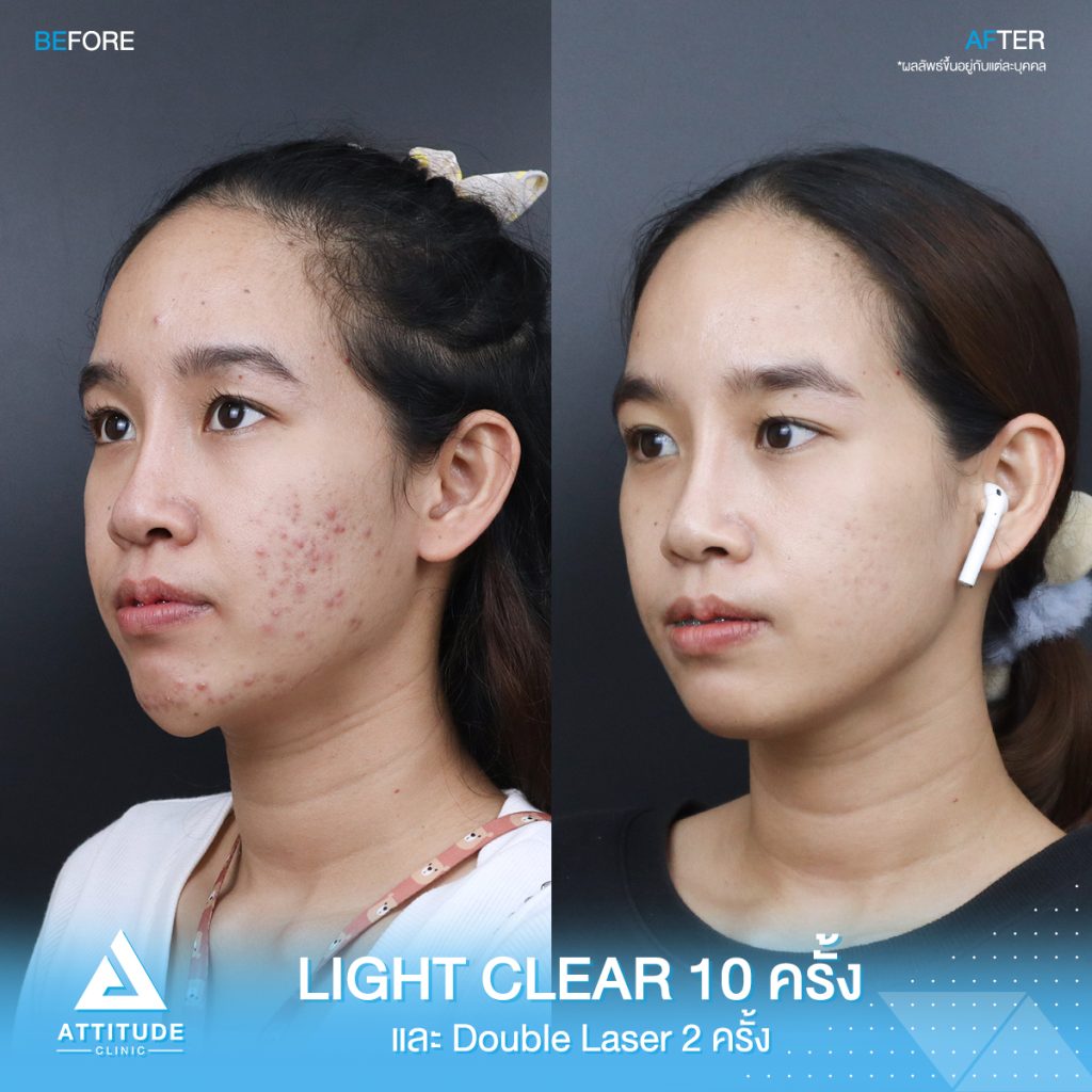 รีวิวรักษาสิวครบวงจร คุณใหม่ โปรแกรม Light Clear รักษาสิวด้วยการฉายแสง 7 ขั้นตอน จำนวน 10 ครั้ง เลเซอร์หน้าใส Cellec V IPL จำนวน 2 ครั้ง เลเซอร์ลดเม็ดสี Q-Switched จำนวน 2 ครั้ง