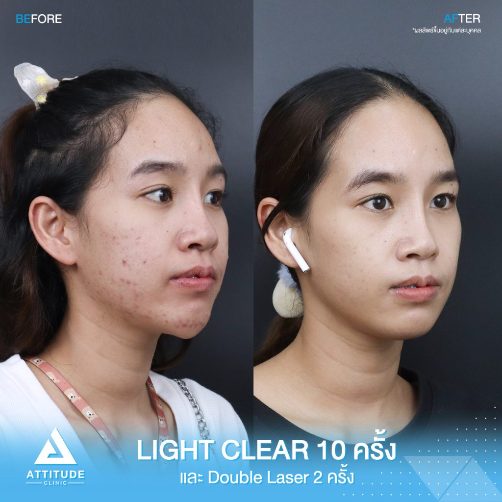 รีวิวรักษาสิวครบวงจร คุณใหม่ โปรแกรม Light Clear รักษาสิวด้วยการฉายแสง 7 ขั้นตอน จำนวน 10 ครั้ง เลเซอร์หน้าใส Cellec V IPL จำนวน 2 ครั้ง เลเซอร์ลดเม็ดสี Q-Switched จำนวน 2 ครั้ง