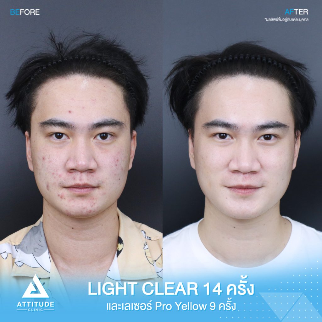 รีวิวรักษาสิวครบวงจร โปรแกรม Light Clear ฉายแสง 7 ขั้นตอน จำนวน 14 ครั้ง และเลเซอร์ Pro Yellow รักษารอยแดง สิวอักเสบโดยเฉพาะ จำนวน 9 ครั้ง ของคุณคริส