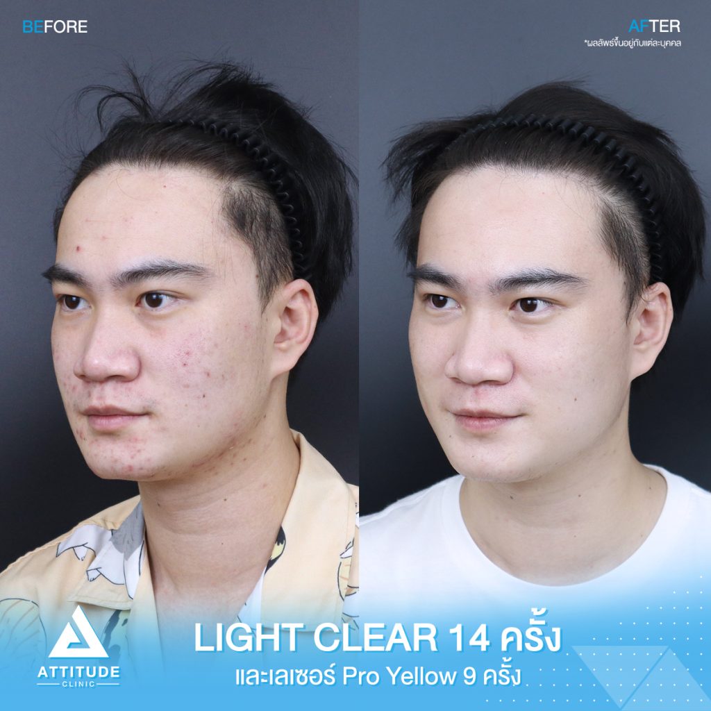 รีวิวรักษาสิวครบวงจร โปรแกรม Light Clear ฉายแสง 7 ขั้นตอน จำนวน 14 ครั้ง และเลเซอร์ Pro Yellow รักษารอยแดง สิวอักเสบโดยเฉพาะ จำนวน 9 ครั้ง ของคุณคริส