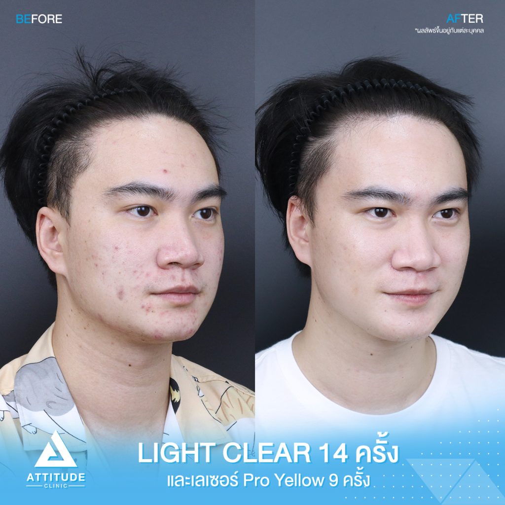 รีวิวรักษาสิวครบวงจร โปรแกรม Light Clear ฉายแสง 7 ขั้นตอน จำนวน 14 ครั้ง และเลเซอร์ Pro Yellow รักษารอยแดง สิวอักเสบโดยเฉพาะ จำนวน 9 ครั้ง ของคุณคริส