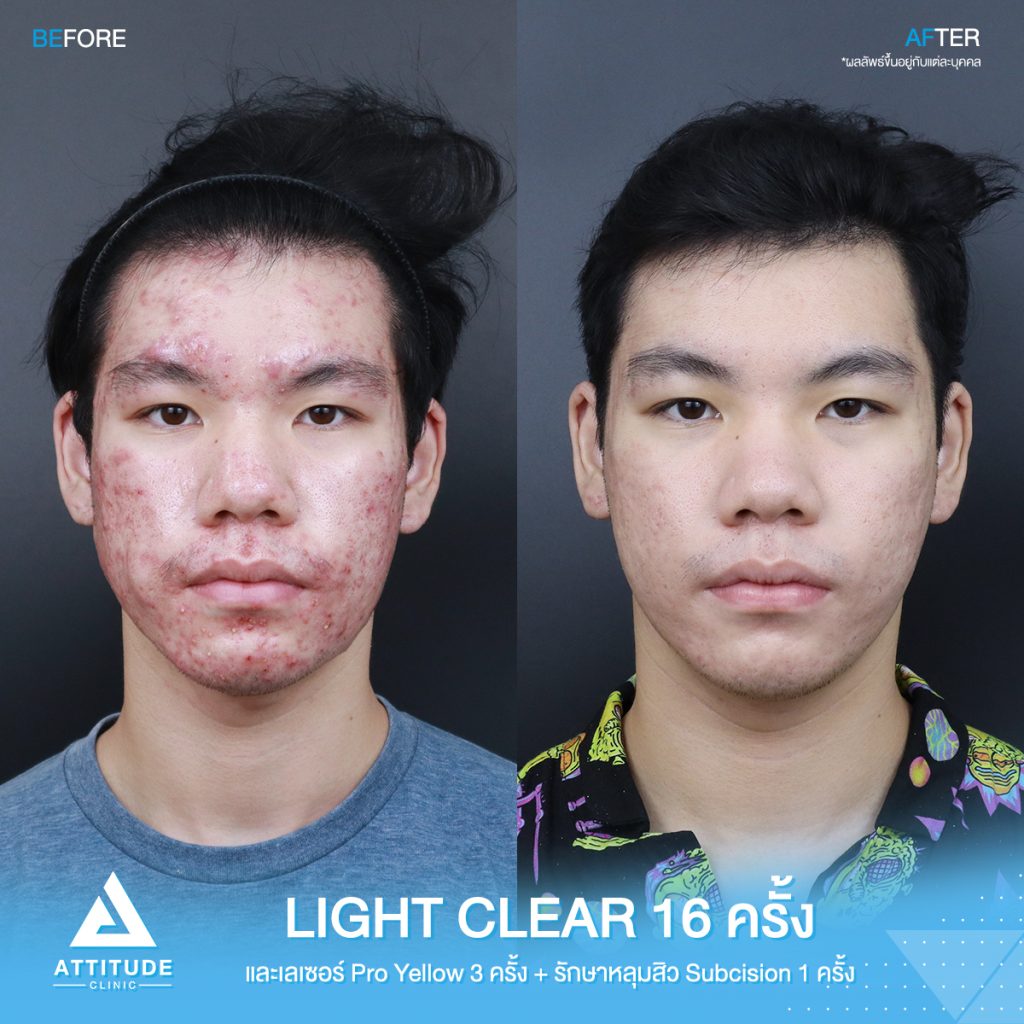 รีวิวรักษาสิวครบวงจร โปรแกรม Light Clear ฉายแสง 7 ขั้นตอน จำนวน 16 ครั้ง และเลเซอร์ Pro Yellow ลดรอยแดง สิวอักเสบโดยเฉพาะ จำนวน 3 ครั้ง และรักษาหลุมสิว Subcision จำนวน 1 ครั้ง ของน้องเต้ย