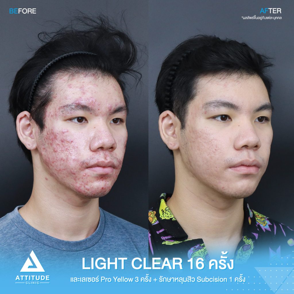 รีวิวรักษาสิวครบวงจร โปรแกรม Light Clear ฉายแสง 7 ขั้นตอน จำนวน 16 ครั้ง และเลเซอร์ Pro Yellow ลดรอยแดง สิวอักเสบโดยเฉพาะ จำนวน 3 ครั้ง และรักษาหลุมสิว Subcision จำนวน 1 ครั้ง ของน้องเต้ย