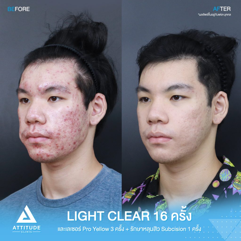 รีวิวรักษาสิวครบวงจร โปรแกรม Light Clear ฉายแสง 7 ขั้นตอน จำนวน 16 ครั้ง และเลเซอร์ Pro Yellow ลดรอยแดง สิวอักเสบโดยเฉพาะ จำนวน 3 ครั้ง และรักษาหลุมสิว Subcision จำนวน 1 ครั้ง ของน้องเต้ย