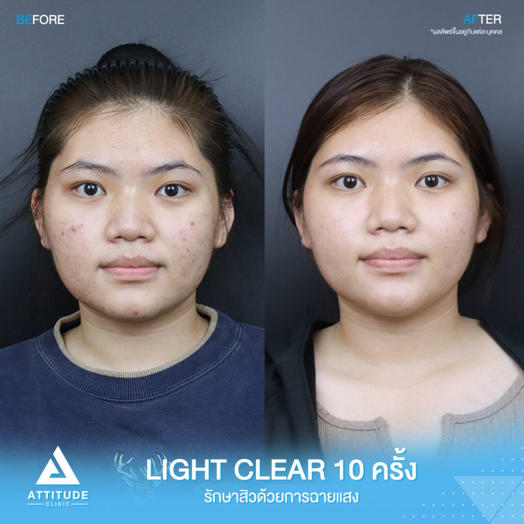 รีวิวรักษาสิวครบวงจร น้องฟิล์ม โปรแกรม Light Clear ด้วยการฉายแสง 7 ขั้นตอน จำนวน 10 ครั้ง สิวอุดตัน สิวอักเสบสิว สิวฮอร์โมน และรอยแดงจากสิว