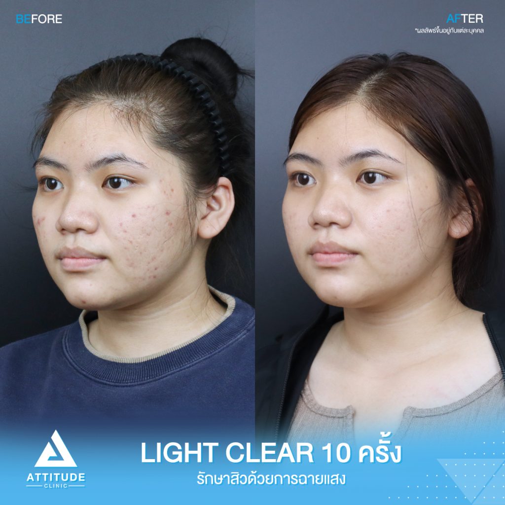 รีวิวรักษาสิวครบวงจร น้องฟิล์ม โปรแกรม Light Clear ด้วยการฉายแสง 7 ขั้นตอน จำนวน 10 ครั้ง สิวอุดตัน สิวอักเสบสิว สิวฮอร์โมน และรอยแดงจากสิว