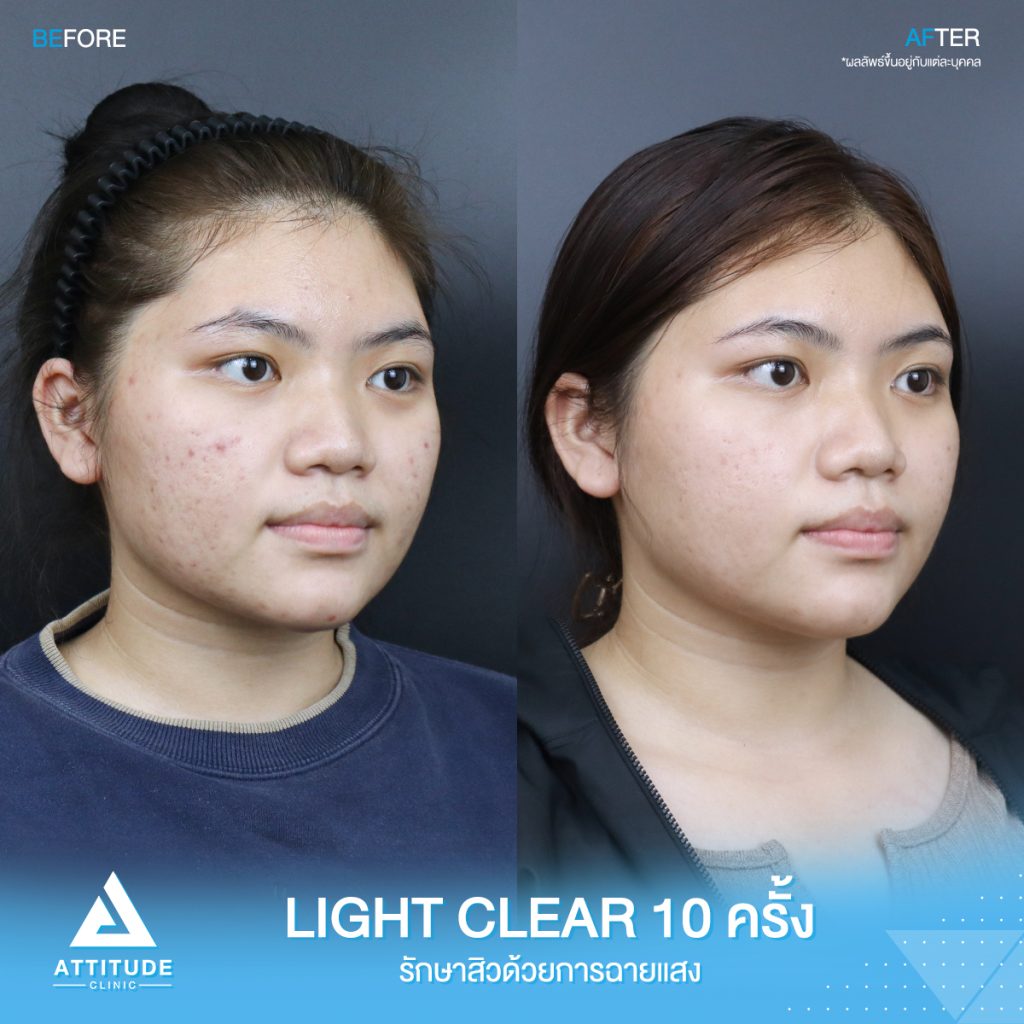 รีวิวรักษาสิวครบวงจร น้องฟิล์ม โปรแกรม Light Clear ด้วยการฉายแสง 7 ขั้นตอน จำนวน 10 ครั้ง สิวอุดตัน สิวอักเสบสิว สิวฮอร์โมน และรอยแดงจากสิว