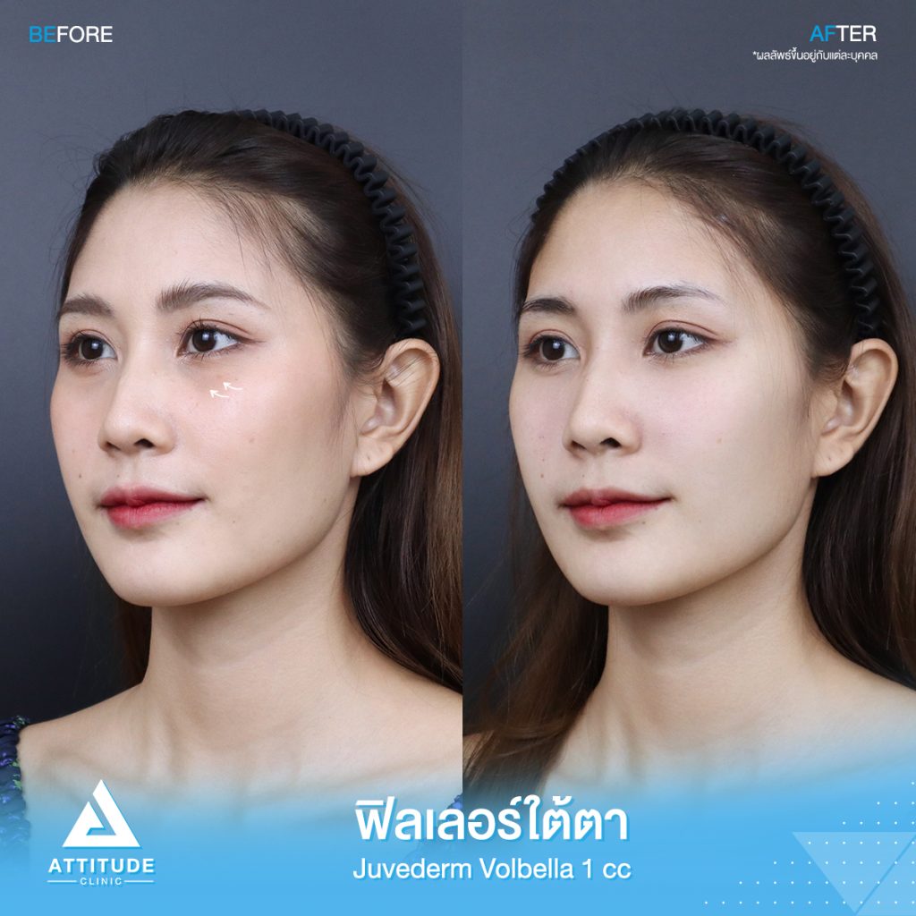 รีวิวฉีดฟิลเลอร์ใต้ตา Juvederm Volbella 1 cc เติมเต็มร่องใต้ตาให้อิ่มฟูสดใส แก้ใต้ตาคล้ำ