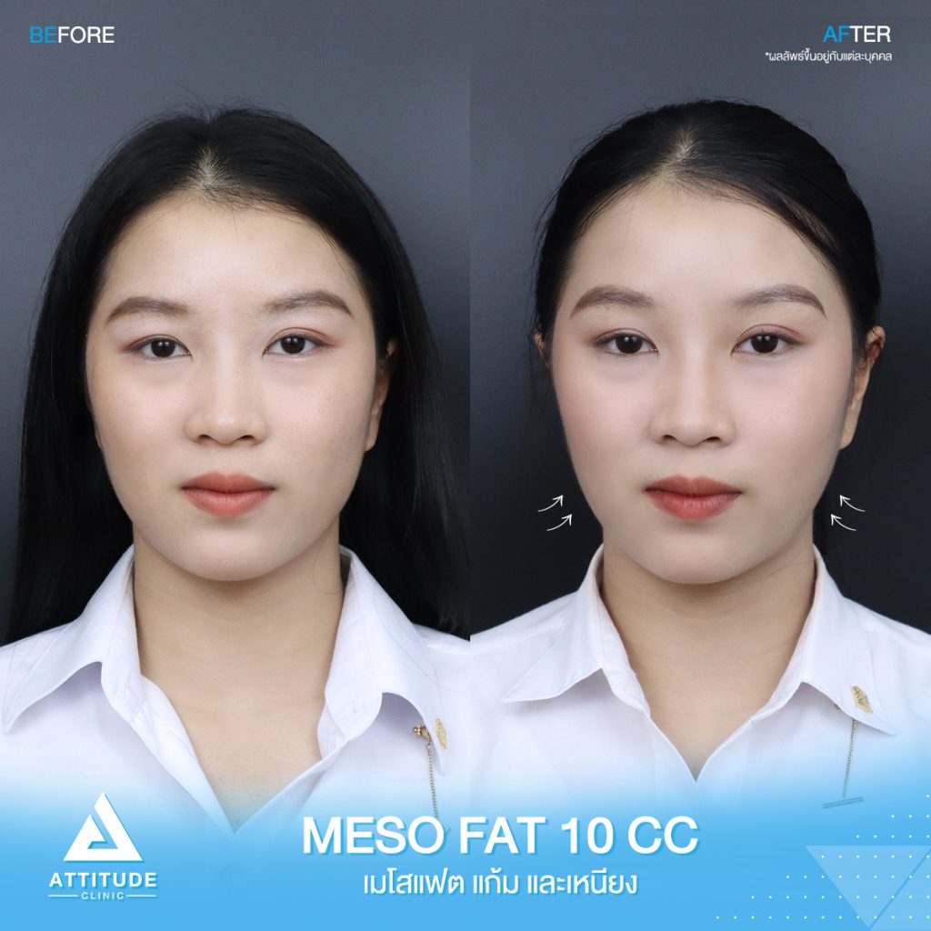 รีวิวปรับรูปหน้า ฉีด Meso Fat จำนวน 10 cc ของน้องแยม สลายไขมัน ปรับรูปหน้า ลดเหนียง หน้าเรียว