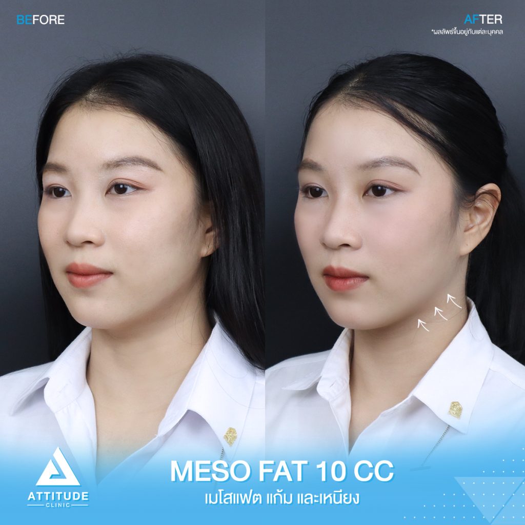รีวิวปรับรูปหน้า ฉีด Meso Fat จำนวน 10 cc ของน้องแยม สลายไขมัน ปรับรูปหน้า ลดเหนียง หน้าเรียว