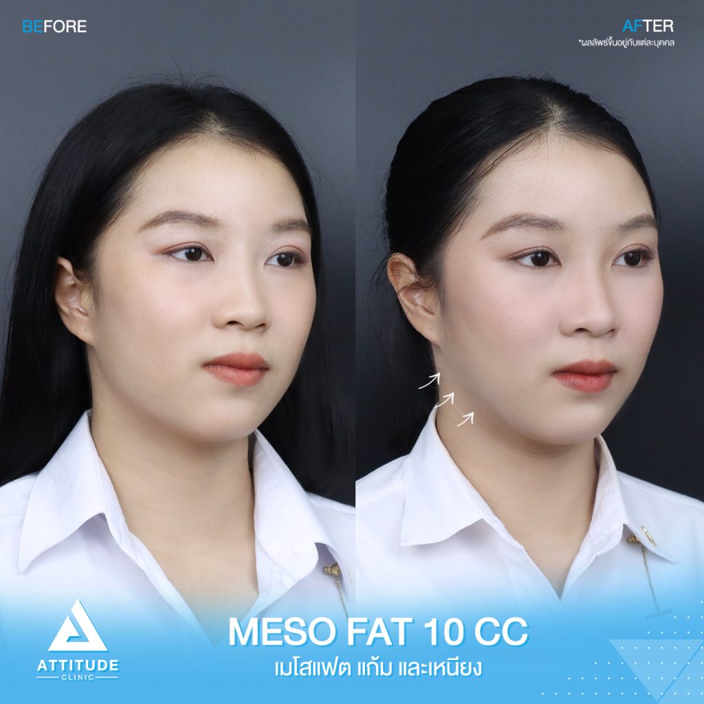 รีวิวปรับรูปหน้า ฉีด Meso Fat จำนวน 10 cc ของน้องแยม สลายไขมัน ปรับรูปหน้า ลดเหนียง หน้าเรียว