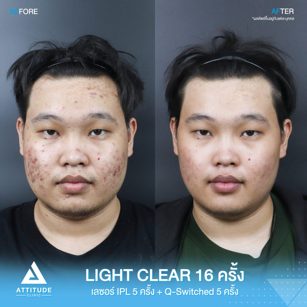 รีวิวรักษาสิวครบวงจร โปรแกรม Light Clear รักษาสิวด้วยการฉายแสง 7 ขั้นตอน จำนวน 16 ครั้ง เลเซอร์หน้าใส Cellec V IPL จำนวน 5 ครั้ง เลเซอร์ลดเม็ดสี Q-Switched จำนวน 5 ครั้ง ของคุณเอิร์ธ