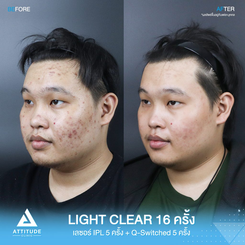 วิวรักษาสิวครบวงจร โปรแกรม Light Clear รักษาสิวด้วยการฉายแสง 7 ขั้นตอน จำนวน 16 ครั้ง เลเซอร์หน้าใส Cellec V IPL จำนวน 5 ครั้ง เลเซอร์ลดเม็ดสี Q-Switched จำนวน 5 ครั้ง ของคุณเอิร์ธ