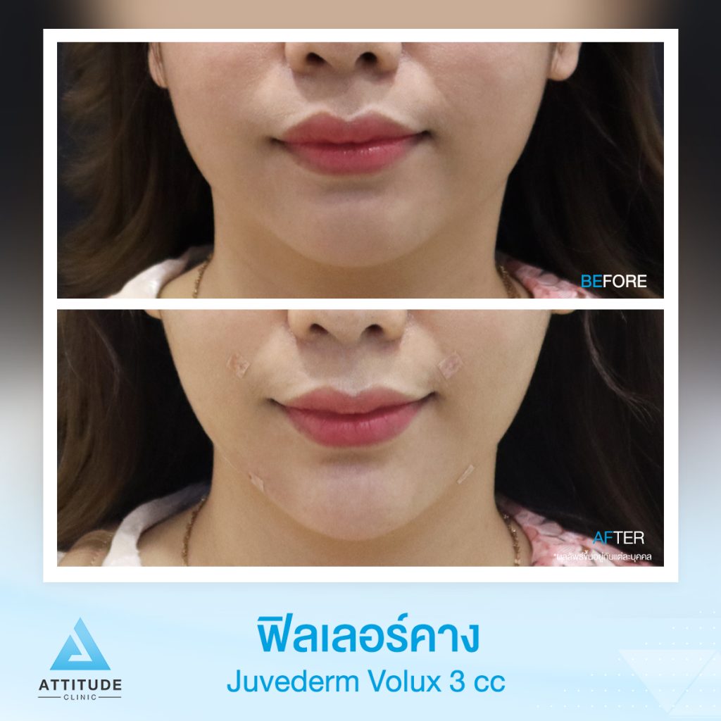 รีวิวฉีดฟิลเลอร์คาง Juvedrem Volux จำนวน 3 cc ปรับรูปหน้าให้คางเต็มสวย แก้ปัญหาคางพับ เติมร่องมุมปากให้เต็ม เก็บฐานคางให้สวยเป๊ะ มีมิติ