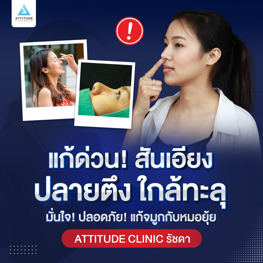 รีวิวเสริมจมูก แก้ปัญหาปลายตึง แกนเอียง
