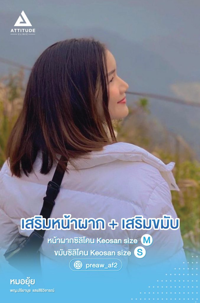 คุณเปรี้ยว AF2 อัพเดทเสริมหน้าผาก เสริมขมับด้วยซิลิโคน สวยนานถาวร ยิ่งนานวันยิ่งเข้าที่ ด้วยเทคนิคและการเลือกขนาดที่พอดีกับรูปหน้าโดยคุณหมอยุ้ย