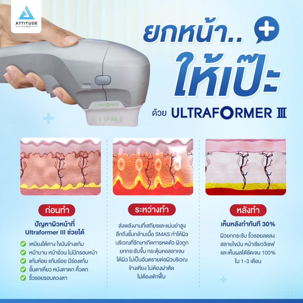 ยกหน้าให้เป๊ะ ด้วย Ultraformer III เทคโนโลยีใหม่ล่าสุด “???? ” ช่วย ยกกระชับผิวหน้า ลดริ้วรอย สลายไขมันใต้ชั้นผิว เห็นผลหลังทำทันที หน้าดูอ่อนกว่าวัย ปรับรูปหน้าให้สวยอย่างเป็นธรรมชาติ 