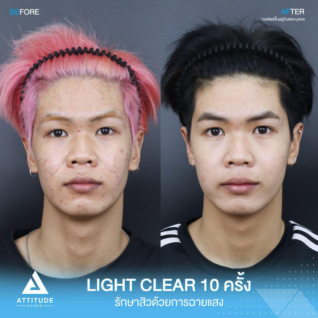 รีวิวรักษาสิวครบวงจร น้องบีมโม่ โปรแกรม Light Clear ด้วยการฉายแสง 7 ขั้นตอน จำนวน 10 ครั้ง ที่มีปัญหาสิวอุดตัน สิวอักเสบสิว สิวฮอร์โมนและรอยแดงจากสิว