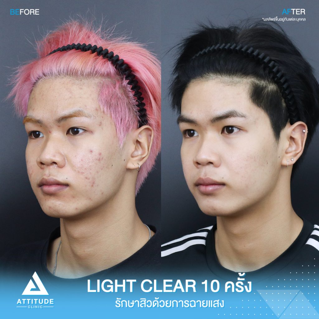 รีวิวรักษาสิวครบวงจร น้องบีมโม่ โปรแกรม Light Clear ด้วยการฉายแสง 7 ขั้นตอน จำนวน 10 ครั้ง ที่มีปัญหาสิวอุดตัน สิวอักเสบสิว สิวฮอร์โมนและรอยแดงจากสิว