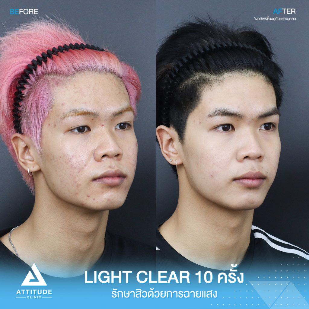 รีวิวรักษาสิวครบวงจร น้องบีมโม่ โปรแกรม Light Clear ด้วยการฉายแสง 7 ขั้นตอน จำนวน 10 ครั้ง ที่มีปัญหาสิวอุดตัน สิวอักเสบสิว สิวฮอร์โมนและรอยแดงจากสิว