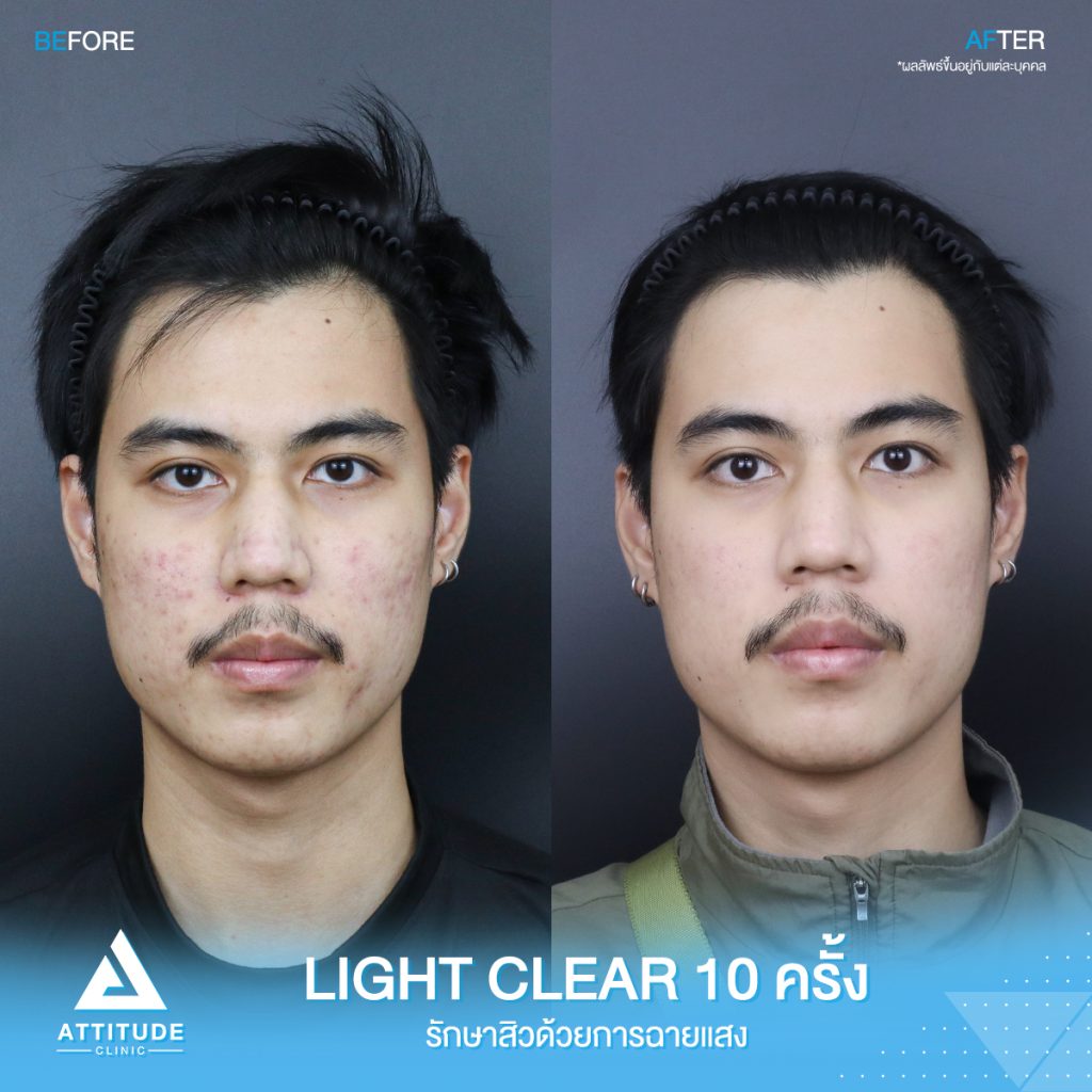 รีวิวรักษาสิวครบวงจร น้องเจม โปรแกรม Light Clear รักษาสิวด้วยการฉายแสง 7 ขั้นตอน จำนวน 10 ครั้ง