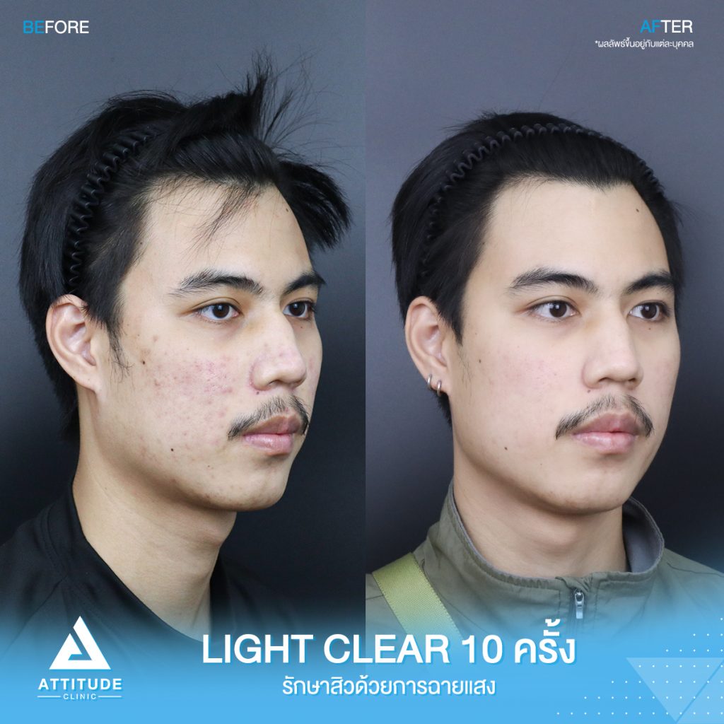 รีวิวรักษาสิวครบวงจร น้องเจม โปรแกรม Light Clear รักษาสิวด้วยการฉายแสง 7 ขั้นตอน จำนวน 10 ครั้ง