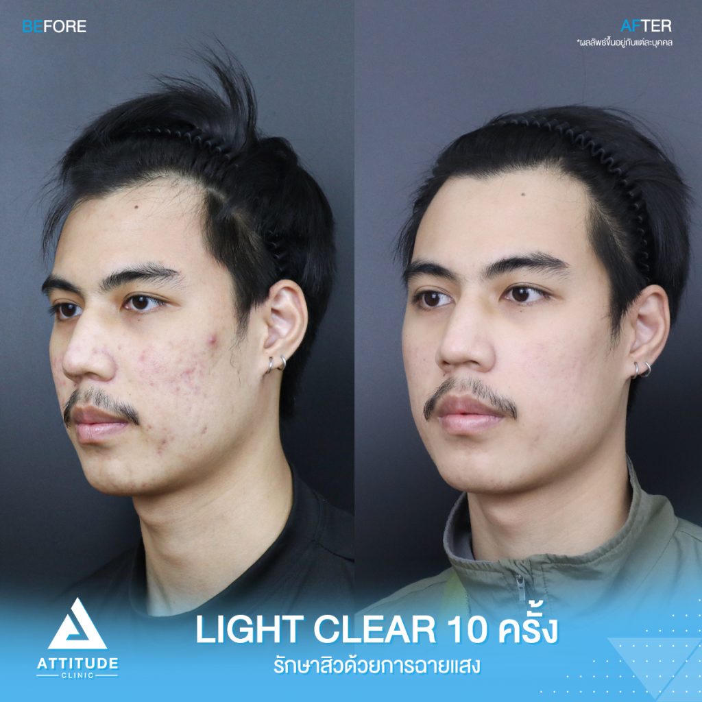 รีวิวรักษาสิวครบวงจร น้องเจม โปรแกรม Light Clear รักษาสิวด้วยการฉายแสง 7 ขั้นตอน จำนวน 10 ครั้ง