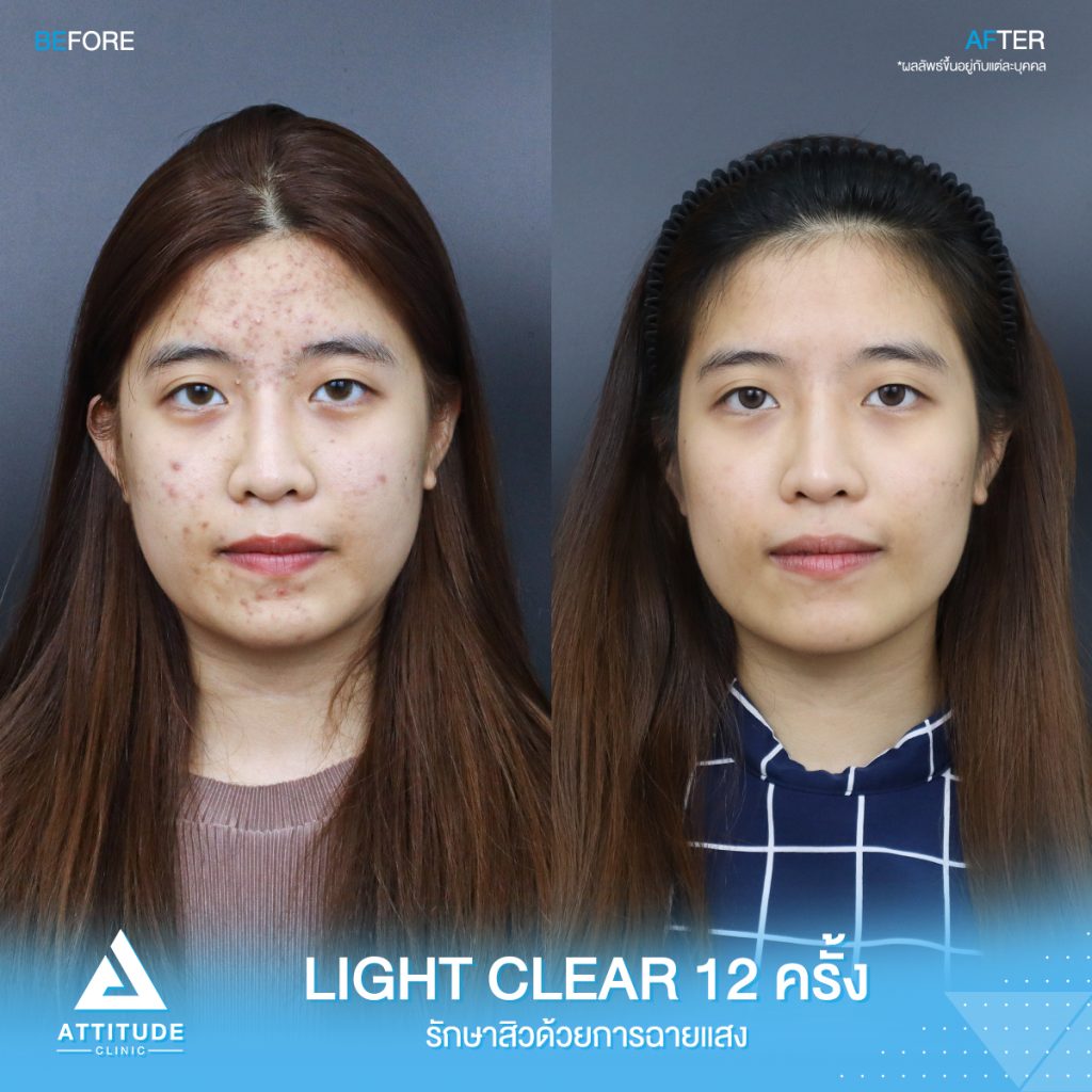 รีวิวรักษาสิวครบวงจร น้องเจน โปรแกรม Light Clear 7 ขั้นตอน จำนวน 12 ครั้ง ที่มีปัญหาสิว รอยสิวจัดเต็ม จนตอนนี้หน้าใสวิ้ง ผิวเรียบเนียนมั่นใจสุดๆ