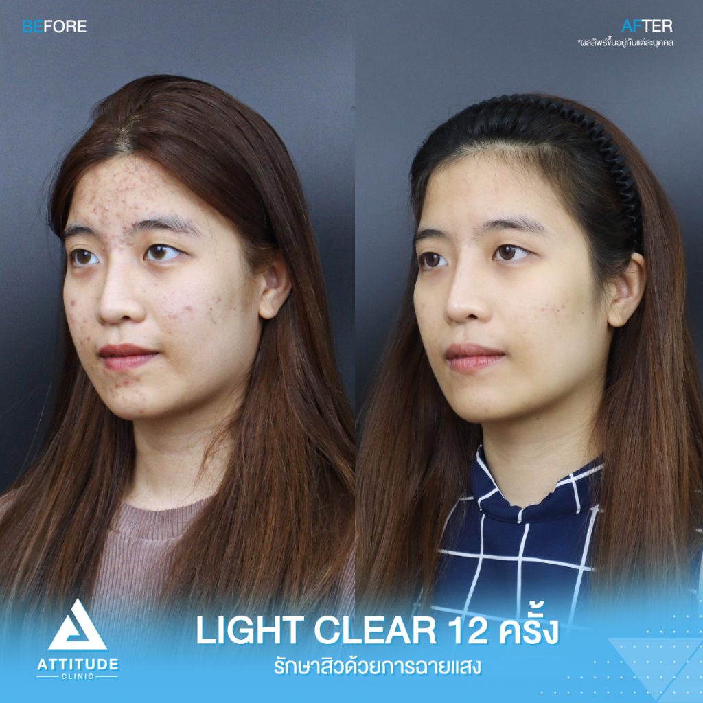 รีวิวรักษาสิวครบวงจร น้องเจน โปรแกรม Light Clear 7 ขั้นตอน จำนวน 12 ครั้ง ที่มีปัญหาสิว รอยสิวจัดเต็ม จนตอนนี้หน้าใสวิ้ง ผิวเรียบเนียนมั่นใจสุดๆ