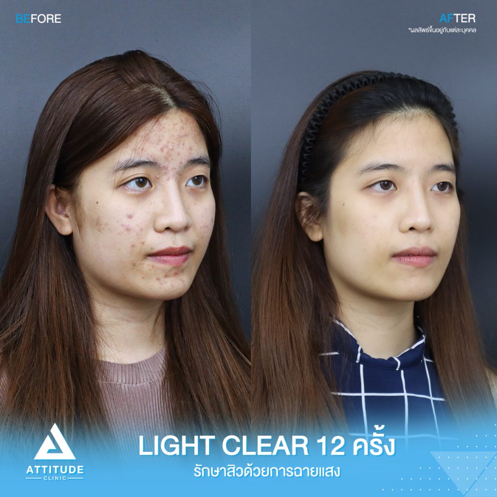 รีวิวรักษาสิวครบวงจร น้องเจน โปรแกรม Light Clear 7 ขั้นตอน จำนวน 12 ครั้ง ที่มีปัญหาสิว รอยสิวจัดเต็ม จนตอนนี้หน้าใสวิ้ง ผิวเรียบเนียนมั่นใจสุดๆ