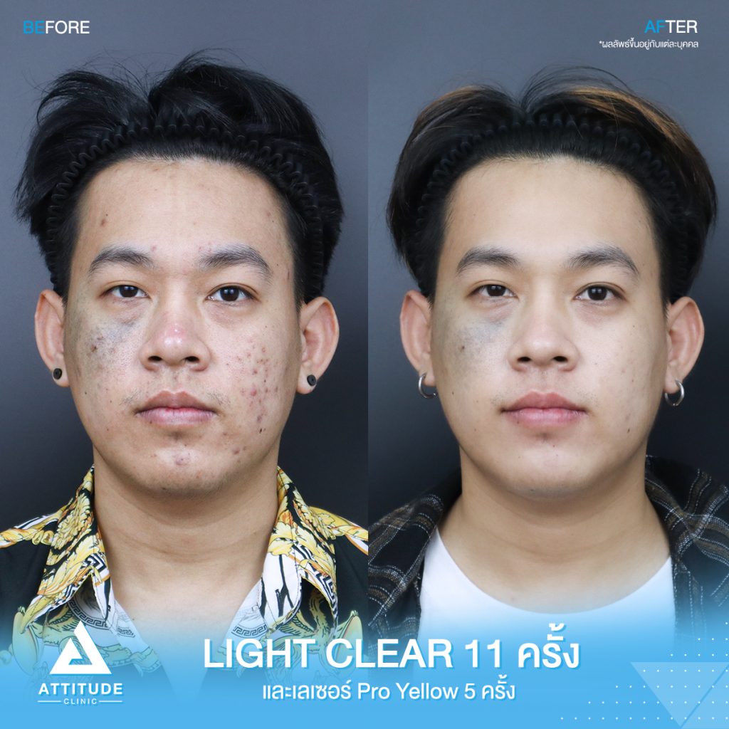 รีวิวรักษาสิวครบวงจร คุณปัท โปรแกรม Light Clear ฉายแสง 7 ขั้นตอน จำนวน 11 ครั้ง และเลเซอร์ Pro Yellow รักษารอยแดง สิวอักเสบโดยเฉพาะ จำนวน 5 ครั้ง สิวหายเกลี้ยง หน้าเนียนกระจ่างใส วิ้งสุดๆ