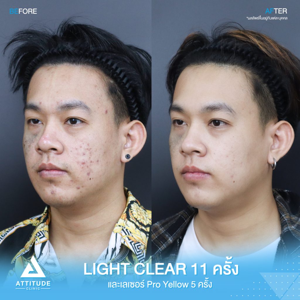 รีวิวรักษาสิวครบวงจร คุณปัท โปรแกรม Light Clear ฉายแสง 7 ขั้นตอน จำนวน 11 ครั้ง และเลเซอร์ Pro Yellow รักษารอยแดง สิวอักเสบโดยเฉพาะ จำนวน 5 ครั้ง สิวหายเกลี้ยง หน้าเนียนกระจ่างใส วิ้งสุดๆ