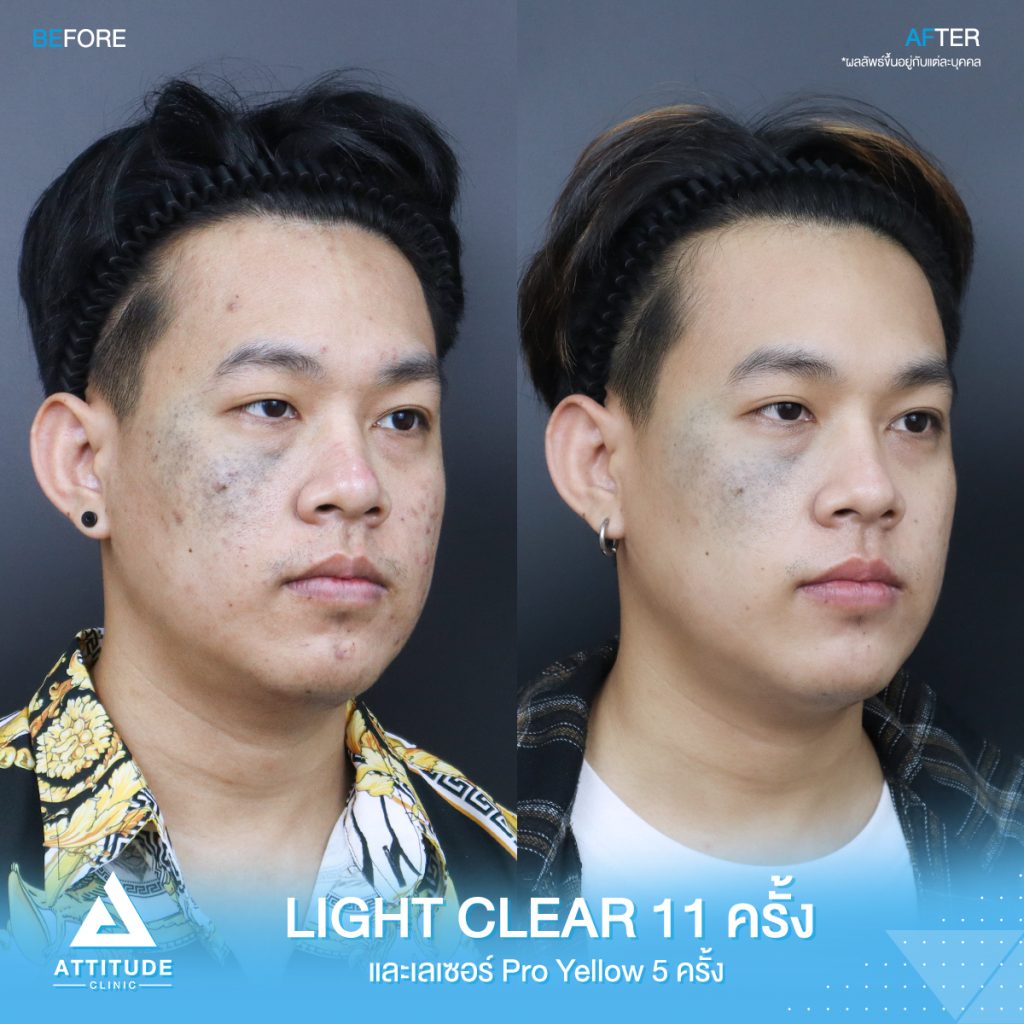 รีวิวรักษาสิวครบวงจร คุณปัท โปรแกรม Light Clear ฉายแสง 7 ขั้นตอน จำนวน 11 ครั้ง และเลเซอร์ Pro Yellow รักษารอยแดง สิวอักเสบโดยเฉพาะ จำนวน 5 ครั้ง สิวหายเกลี้ยง หน้าเนียนกระจ่างใส วิ้งสุดๆ