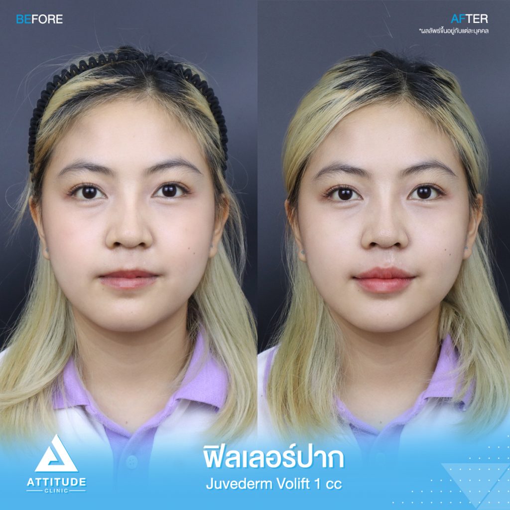 #รีวิวฉีดฟิลเลอร์ปาก Juvederm Volift จำนวน 1 cc เติมเต็มปากให้อวบอิ่ม สวยปัง น่าจุ๊บ หันมุมไหนก็มั่นใจ ด้วยฟิลเลอร์แท้ คุณหมอเชี่ยวชาญ