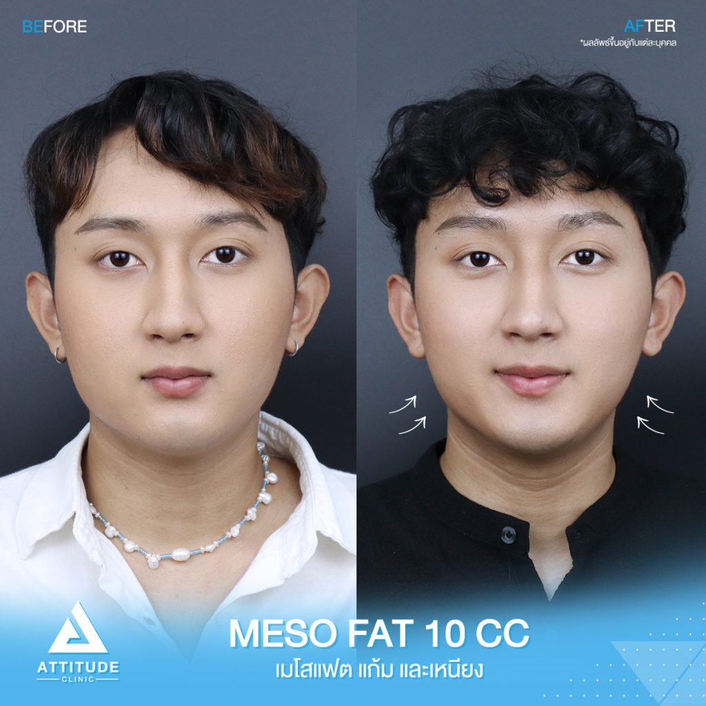 รีวิวฉีด Mesofat