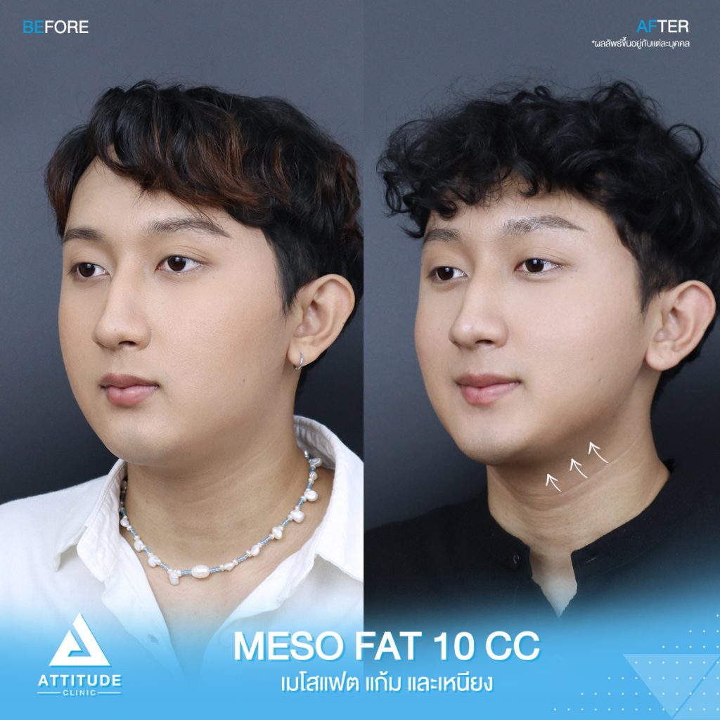 รีวิวฉีด Mesofat