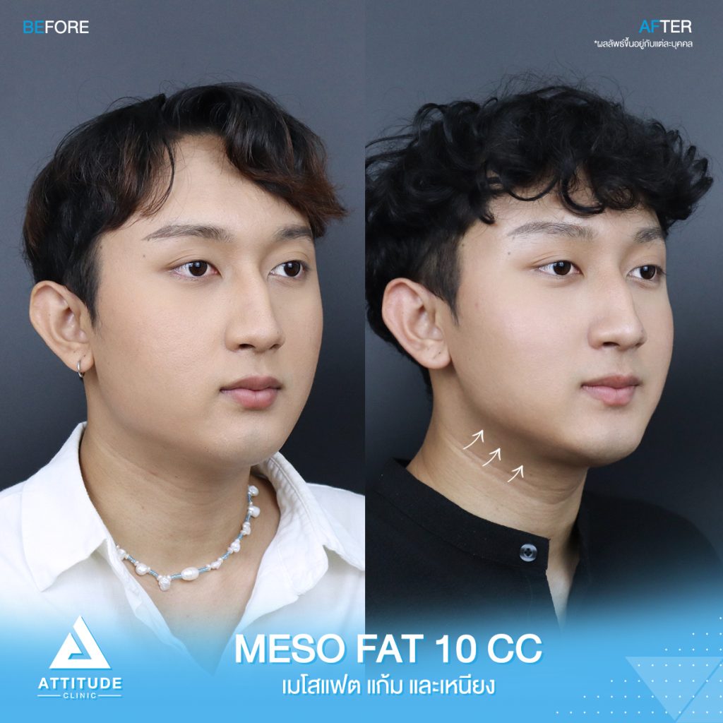 รีวิวฉีด Mesofat
