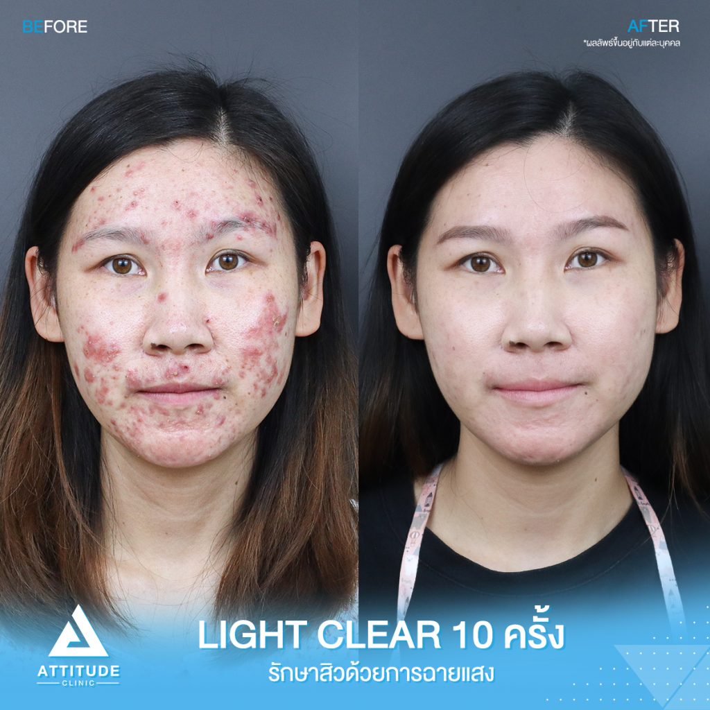 รีวิวรักษาสิวครบวงจร น้องแพรว โปรแกรม Light Clear 7 ขั้นตอน จำนวน 10 ครั้ง ที่มีปัญหาสิว รอยสิวจัดเต็ม จนตอนนี้หน้าใสวิ้ง ผิวเรียบเนียนมั่นใจสุดๆ