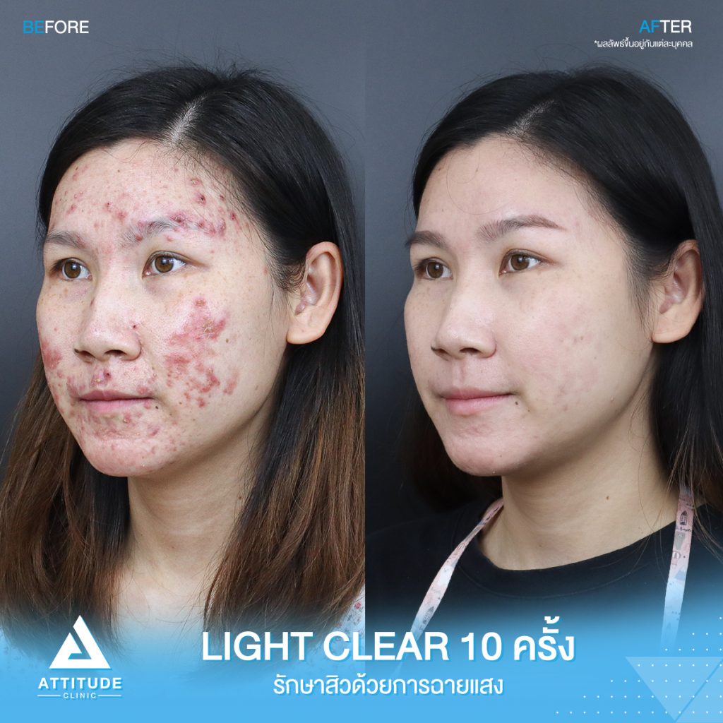 รีวิวรักษาสิวครบวงจร น้องแพรว โปรแกรม Light Clear 7 ขั้นตอน จำนวน 10 ครั้ง ที่มีปัญหาสิว รอยสิวจัดเต็ม จนตอนนี้หน้าใสวิ้ง ผิวเรียบเนียนมั่นใจสุดๆ