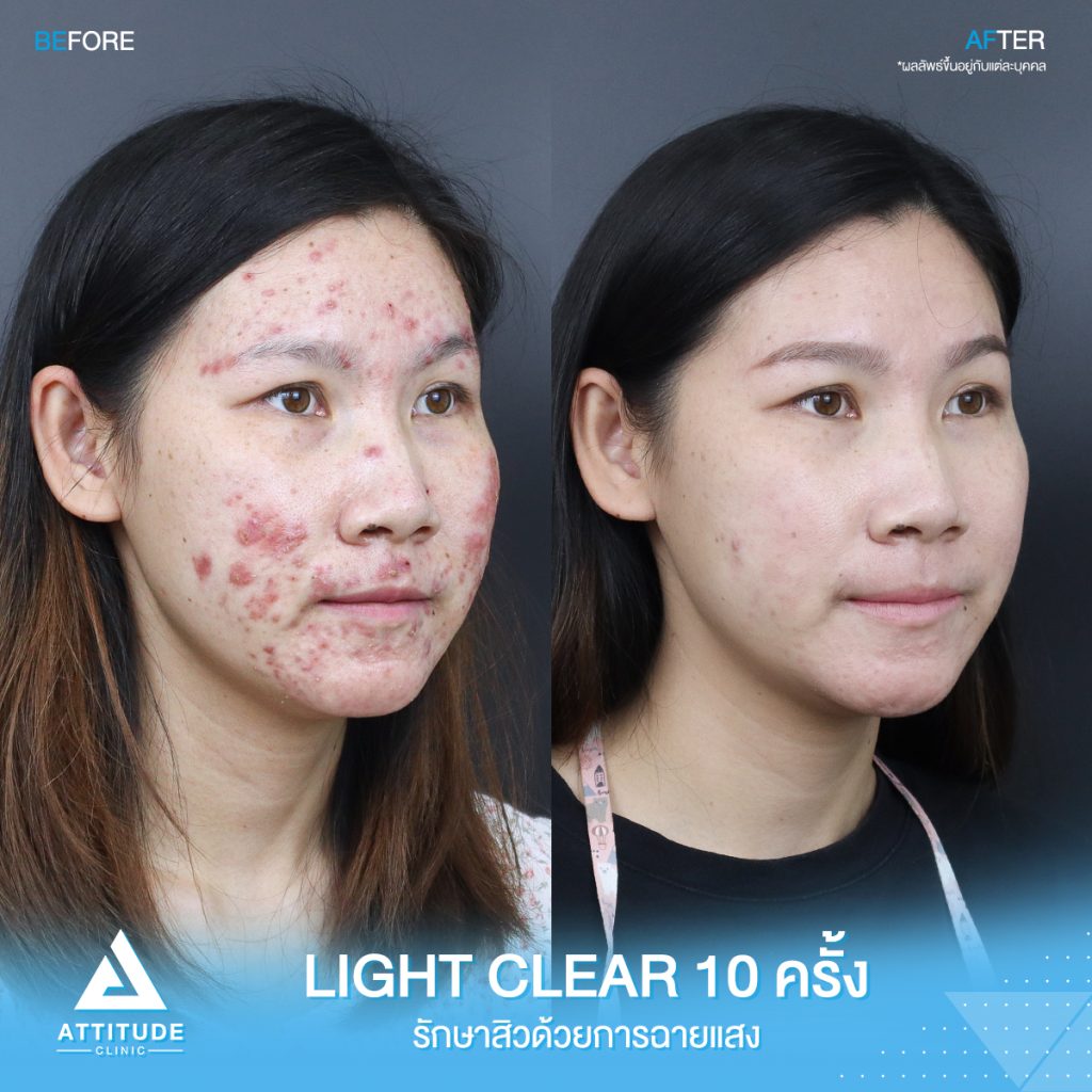 รีวิวรักษาสิวครบวงจร น้องแพรว โปรแกรม Light Clear 7 ขั้นตอน จำนวน 10 ครั้ง ที่มีปัญหาสิว รอยสิวจัดเต็ม จนตอนนี้หน้าใสวิ้ง ผิวเรียบเนียนมั่นใจสุดๆ